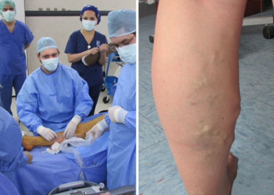 Tratamiento Para Las Varices Cirugia Con Laser Y Radiofrecuencia El Nortero Cl Noticias De Antofagasta Y Calama